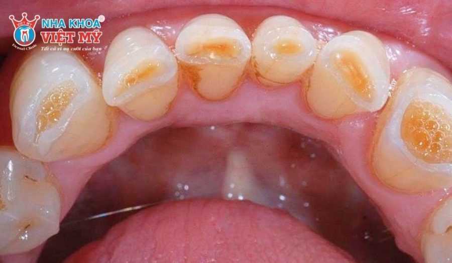 Mòn men răng cần được điều trị nha khoa sớm