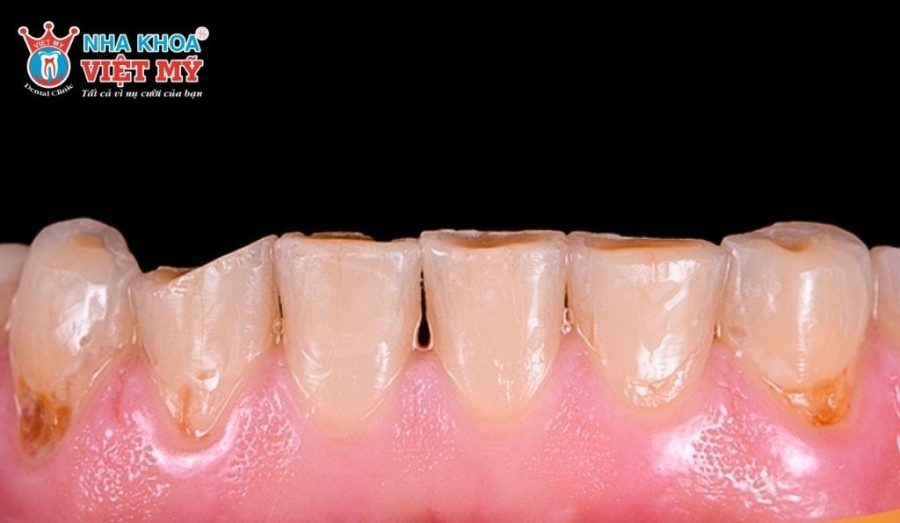 Mòn men răng được chia thành ba nhóm chính