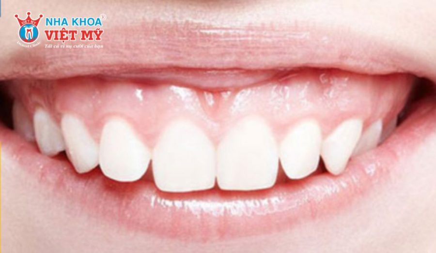 Nguyên nhân niềng răng xong bị hô là gì?