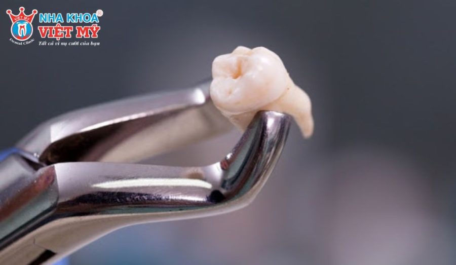 Những trường hợp cần phải nhổ răng trước khi bọc răng sứ