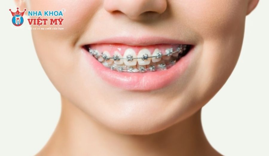 Niềng răng mắc cài kim loại