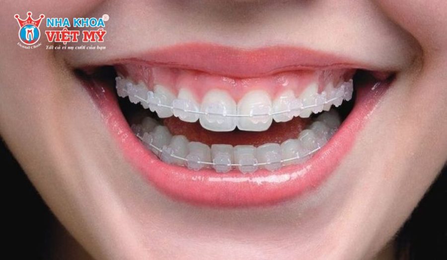 Niềng răng mắc cài sứ