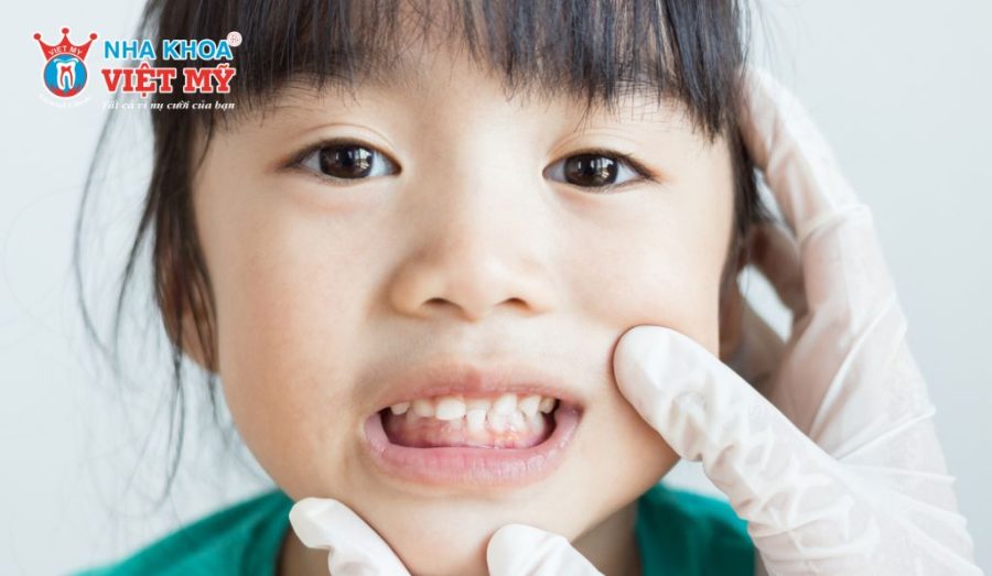 Trẻ em niềng răng có ảnh hưởng đến phát âm không?