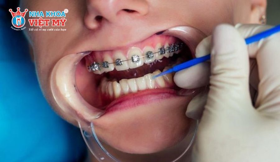 Trẻ niềng răng chi phí có đắt không?