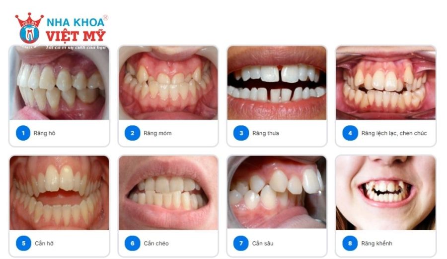 Dấu hiệu nhận biết nên cho trẻ đi niềng răng sớm