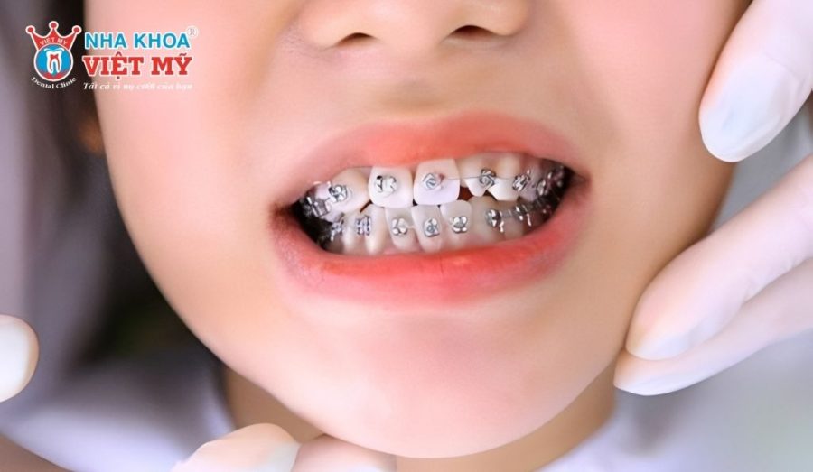 Có nên niềng răng cho trẻ hay không?