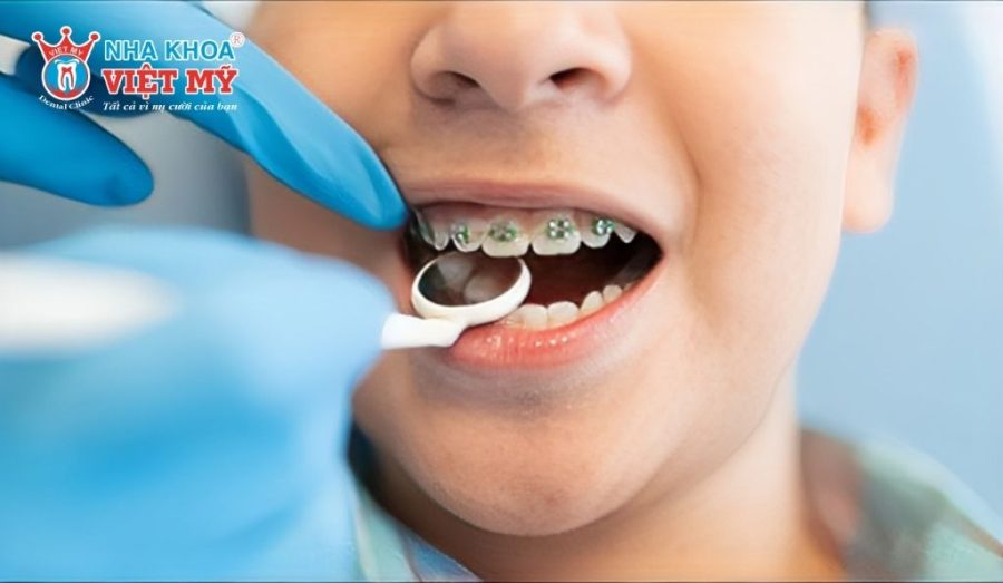 Độ tuổi phù hợp cho trẻ niềng răng