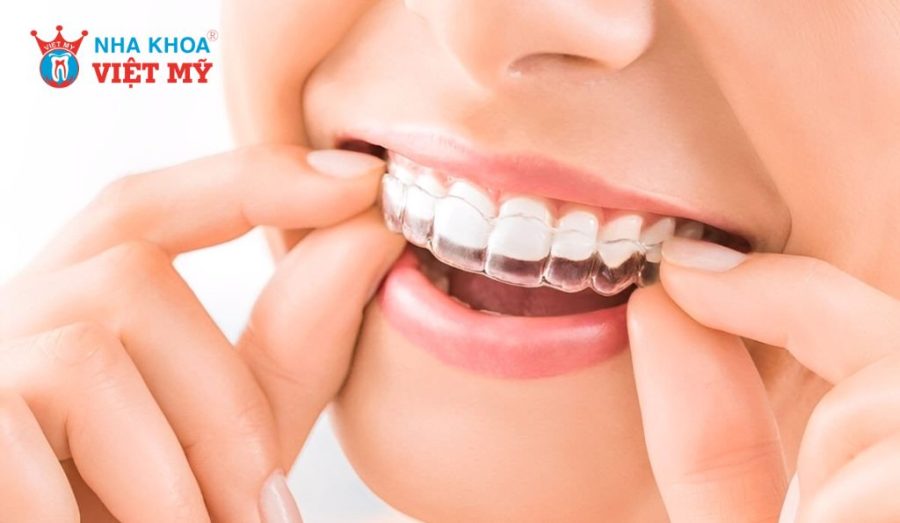 Niềng răng trong suốt