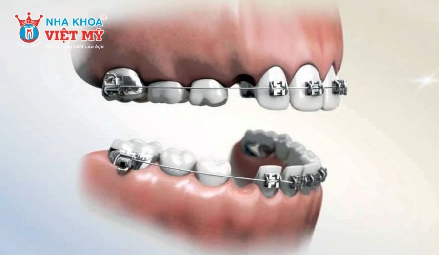 Niềng răng có cần phải nhổ răng không?