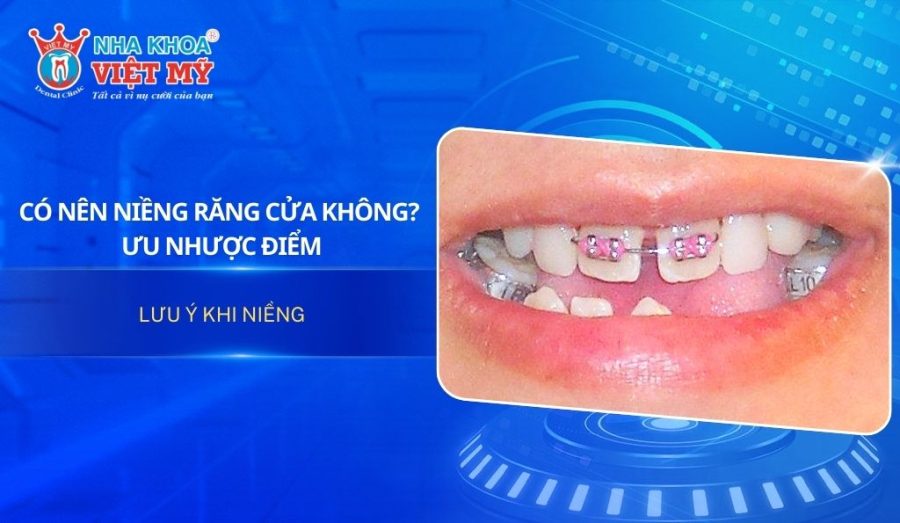 Có nên niềng răng cửa không? Ưu nhược điểm & lưu ý khi niềng