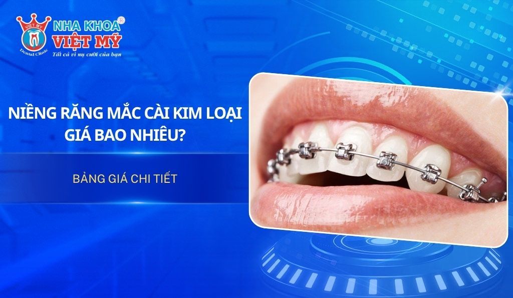 Niềng răng mắc cài kim loại giá bao nhiêu? Bảng giá chi tiết 2025