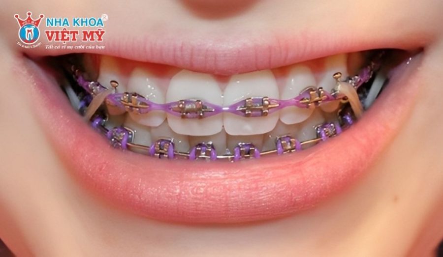 Niềng răng mắc cài kim loại truyền thống có mức giá từ 30 đến 40 triệu VND