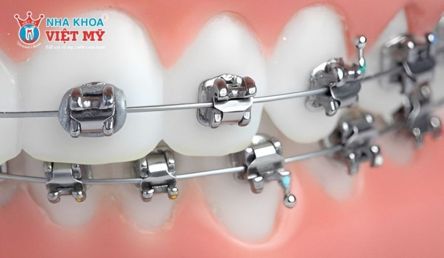 Niềng răng mắc cài kim loại tự khóa có mức giá từ 35 đến 45 triệu VND