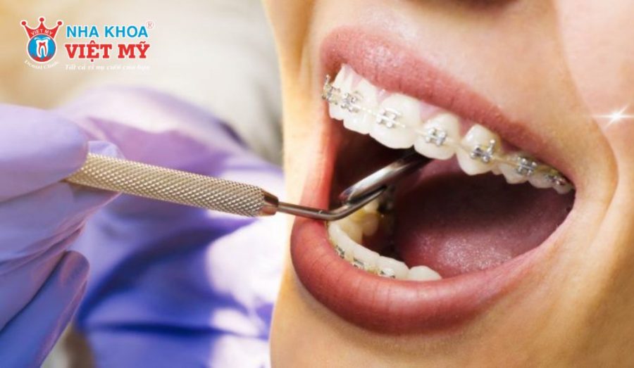 Niềng răng cần phải nhổ bao nhiêu răng?