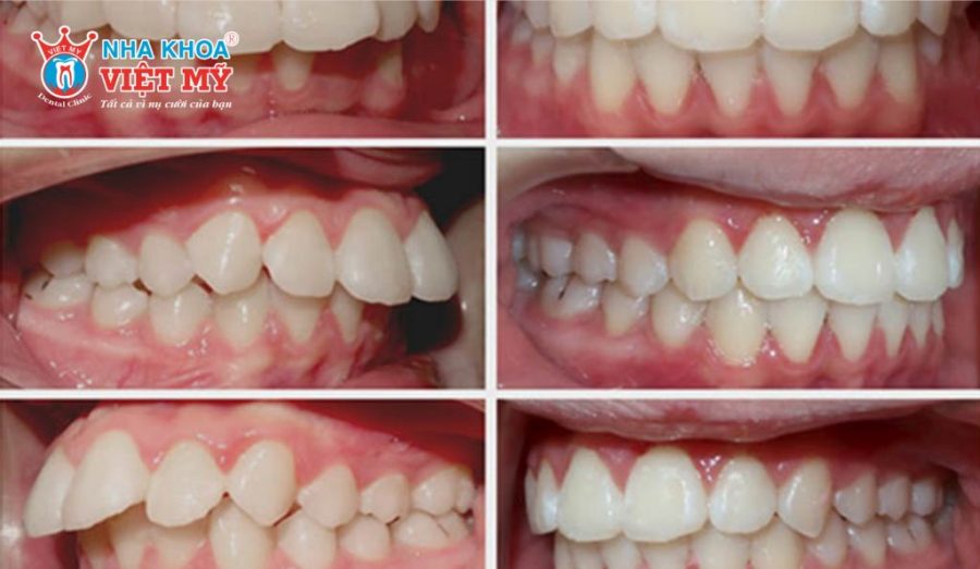 Niềng răng xong bị hô gây ảnh hưởng thẩm mỹ nghiêm trọng.