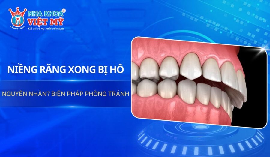 Vì sao niềng răng xong bị hộ? Giải pháp là gì?