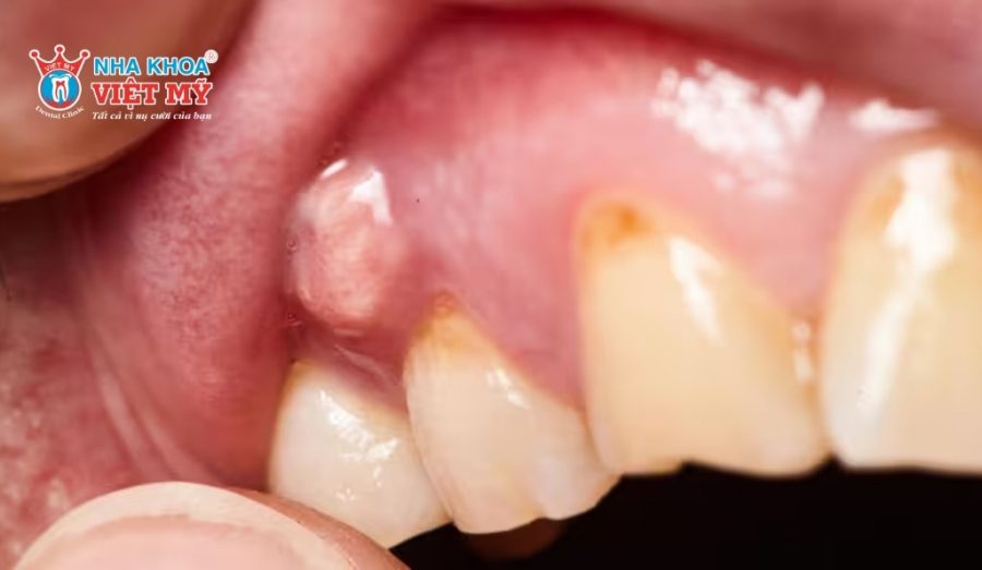 Nướu nhiễm trùng khi lấy cao răng ở địa chỉ không đảm bảo