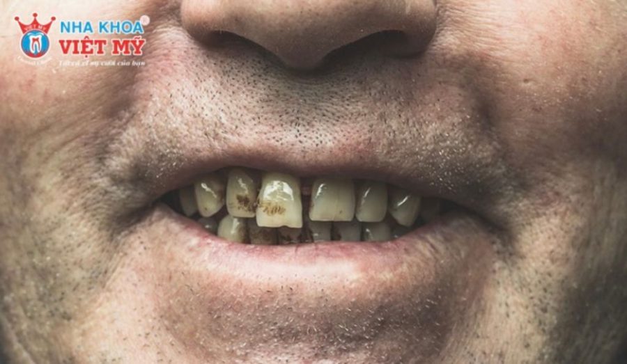 Răng bị đen ở kẽ ảnh hưởng gì đến sức khoẻ và thẩm mỹ
