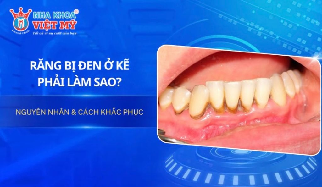 Răng bị đen ở kẽ phải làm sao? Nguyên nhân & Cách khắc phục