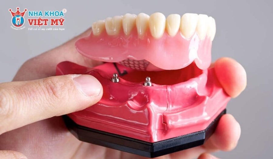 Răng giả tháo lắp trên trụ Implant