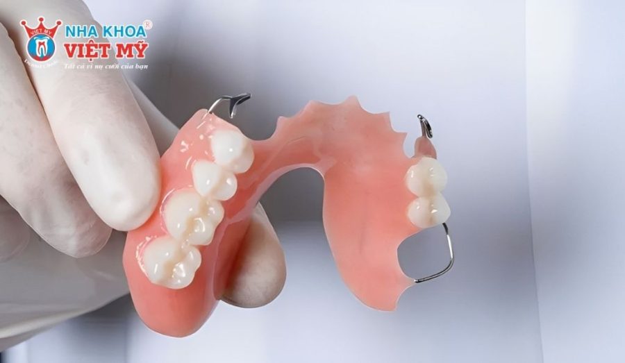 Răng giả tháo lắp khung kim loại