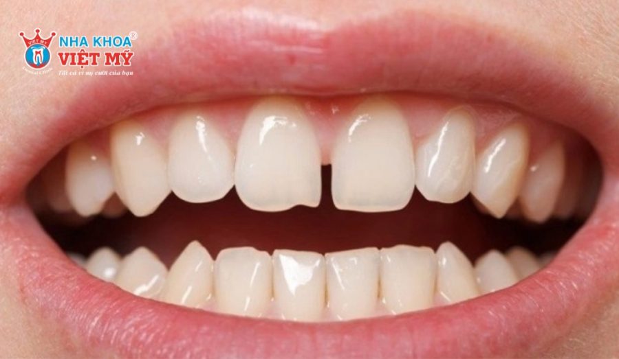 Dán sứ Veneer phù hợp cho người răng không đều mục độ nhẹ đến trung bình