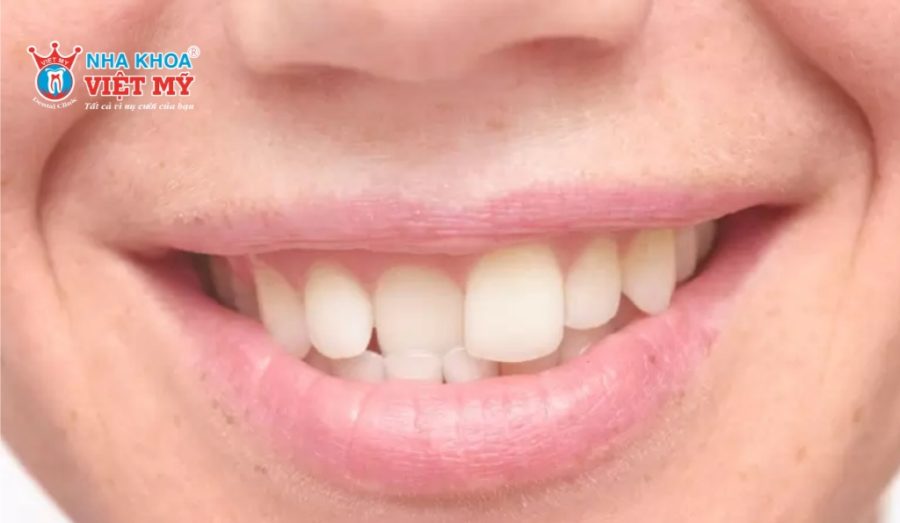 Hình ảnh răng mọc không đều gây mất thẩm mỹ