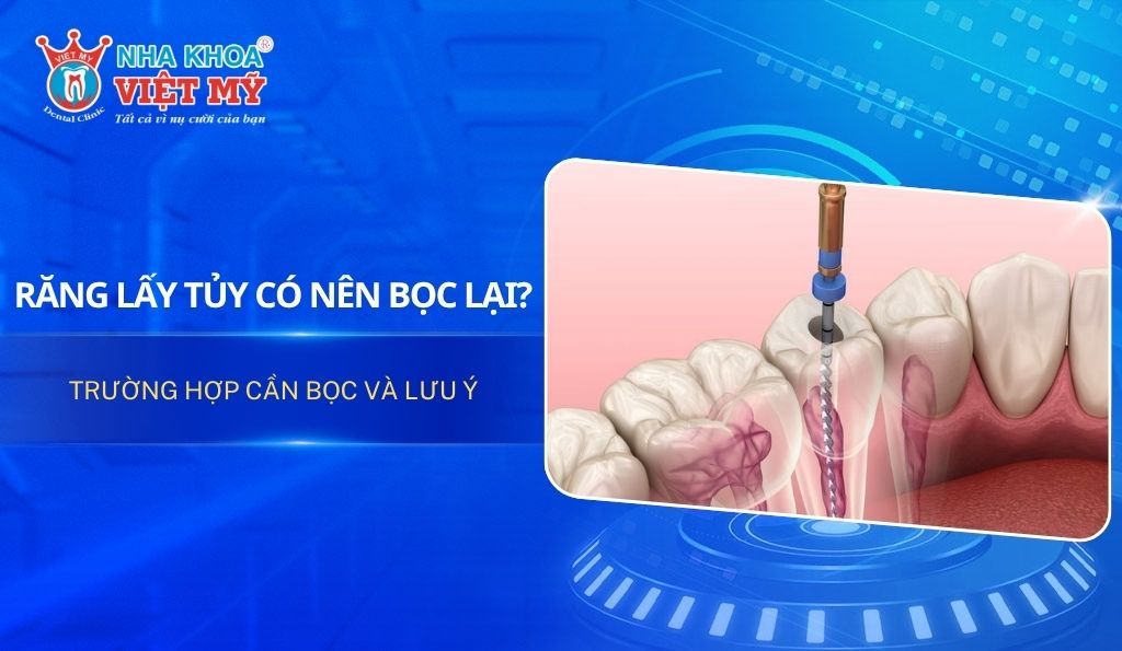 Răng lấy tủy có nên bọc lại? Trường hợp cần bọc và lưu ý