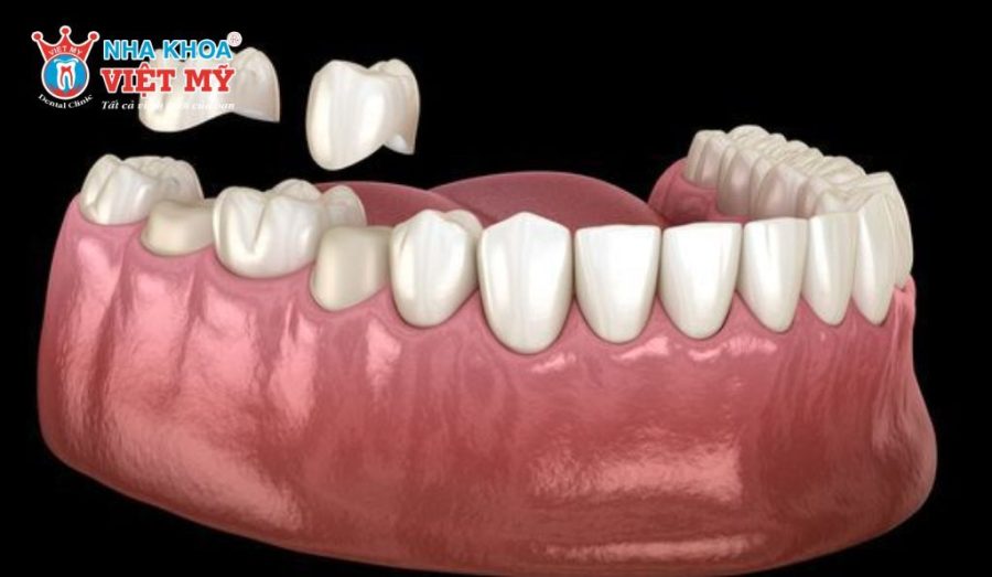 Gắn răng sứ và kiểm tra khớp cắn