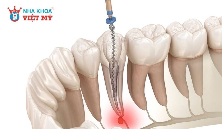Lấy tủy răng là gì? Khi nào cần lấy tủy?