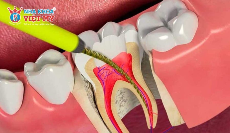 Bọc răng sứ sau khi lấy tủy có đau không?