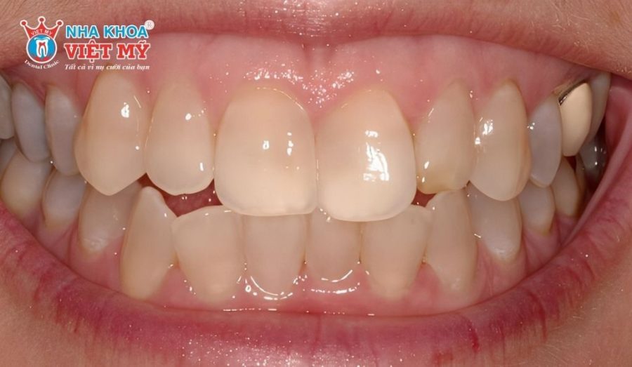 Răng bị đổi màu, sẫm màu sau khi lấy tủy