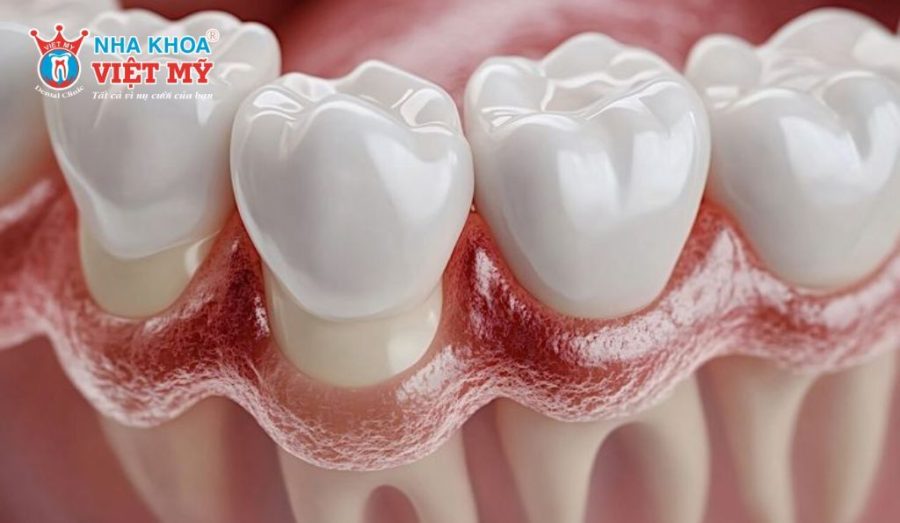 Răng lấy tủy có nên bọc lại? Chi phí thực hiện là bao nhiêu?