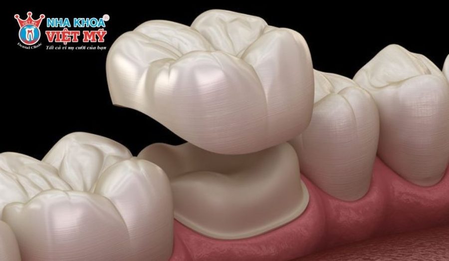 Răng lấy tủy có nên bọc lại không?