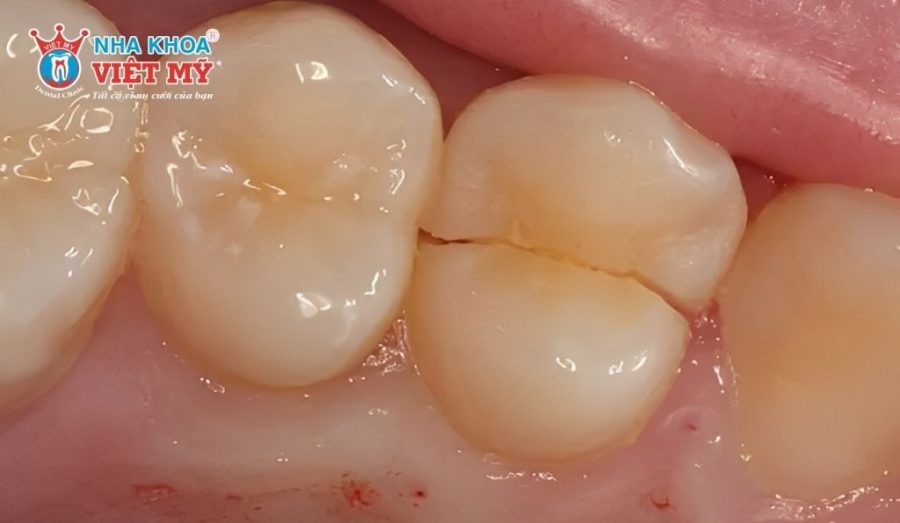 Răng giòn, dễ gãy vỡ khi ăn nhai sau khi lấy tủy