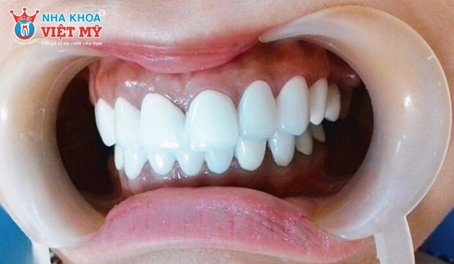 Chọn răng sứ kém chất lượng là nguyên nhân phổ biến gây hiện tượng trắng đục