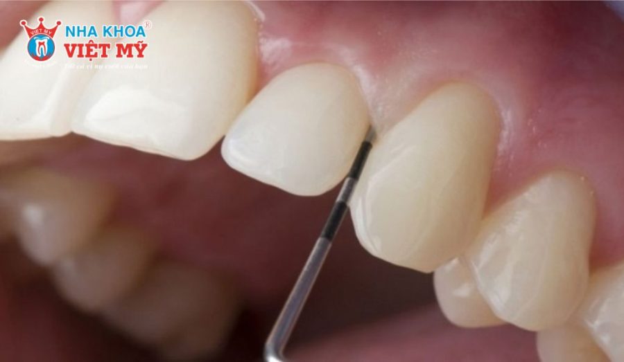 Bác sĩ không có chuyên môn có thể để lại hệ quả nguy hiểm sau bọc răng sứ.