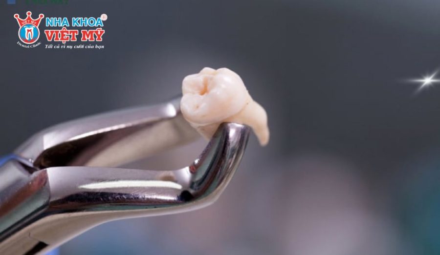 So sánh nhổ răng tại nha khoa uy tín và nha khoa giá rẻ.