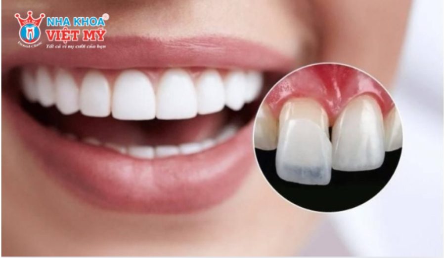 Chi phí dán sứ Veneer tại nha khoa