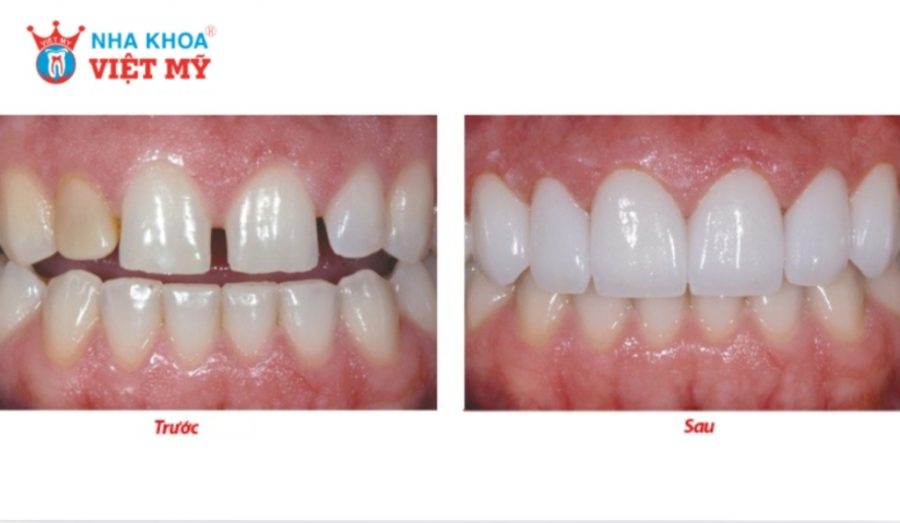 Răng thưa nhẹ nên dán sứ cải thiện thẩm mỹ