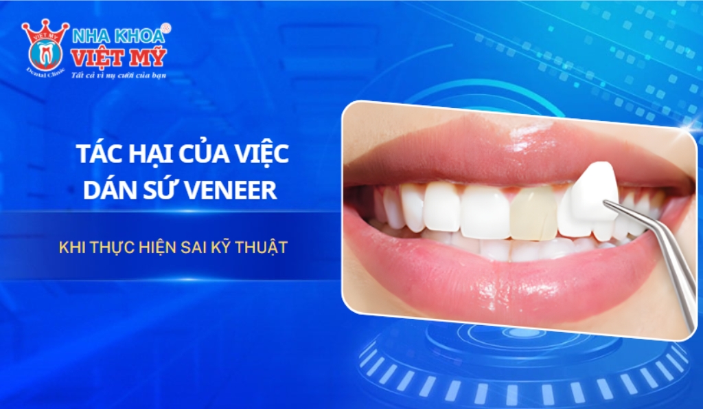 Tác hại của dán sứ Veneer khi thực hiện sai kỹ thuật