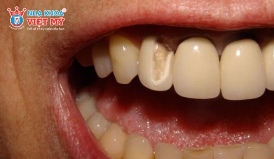 Dán sứ Veneer không đạt chuẩn gây viêm nhiễm