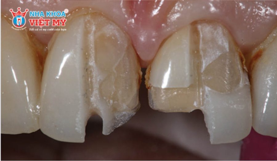 Tác hại của dán sứ Veneer