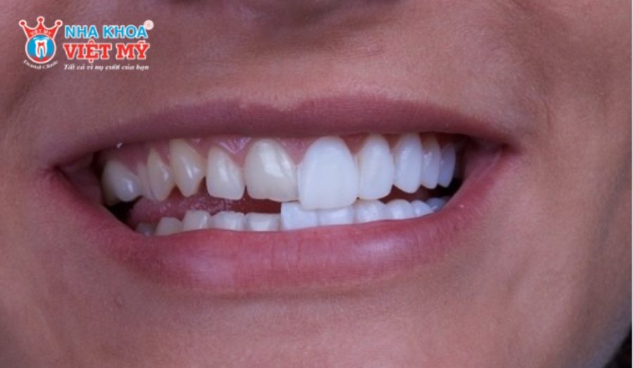 Quy trình dán sứ Veneer chuẩn y khoa