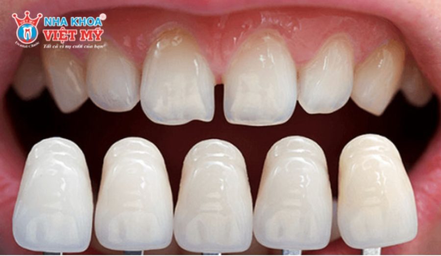 Phương pháp dán sứ Veneer giúp giữ lại răng thật nhiều nhất có thể