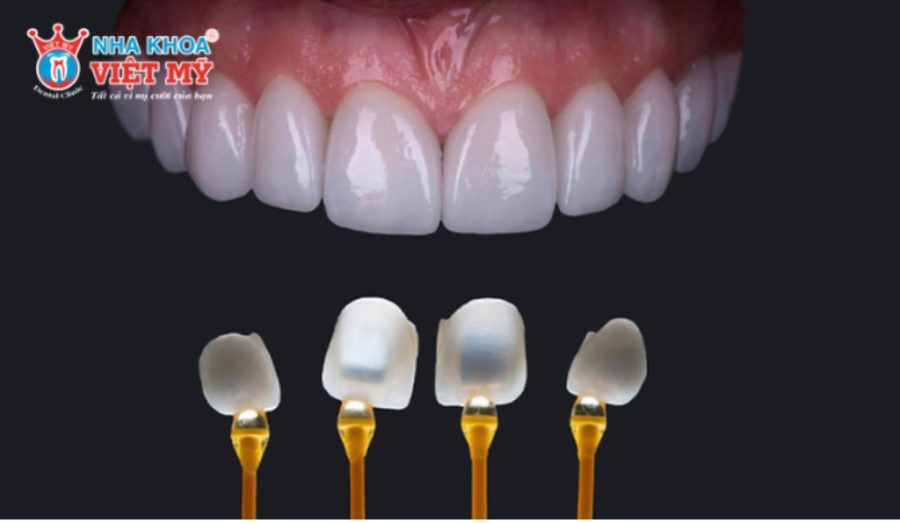 Những câu hỏi thường gặp về dán răng sứ