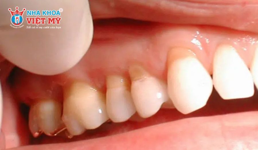 Những nguyên nhân khiến khách hàng lựa chọn bọc răng sứ giá rẻ.