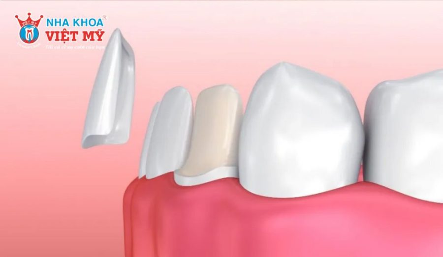 Khách hàng cần tìm hiểu kỹ các loại răng sứ trước khi bọc