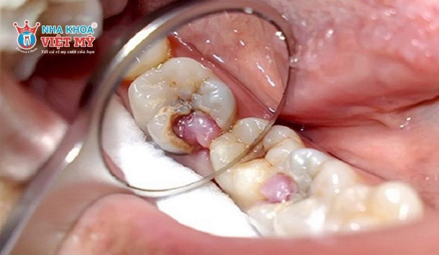 Tình trạng răng trước điều trị tủy bị viêm nhiễm nặng