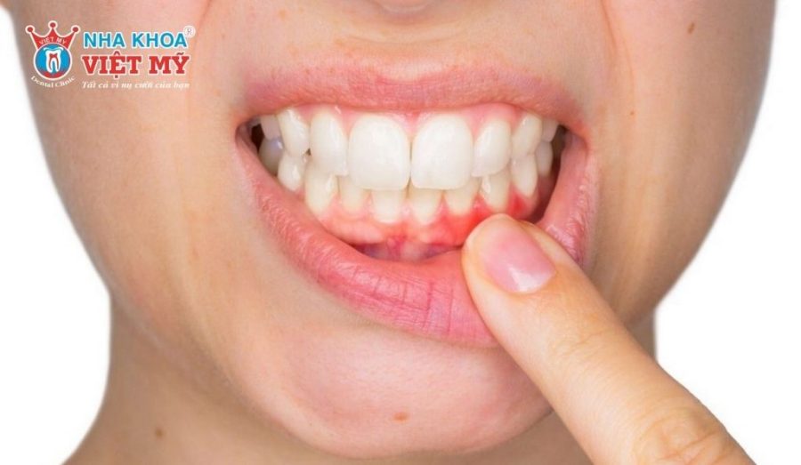 Tình trạng sức khỏe răng miệng ảnh hưởng đến chi phí niềng răng mắc cài kim loại